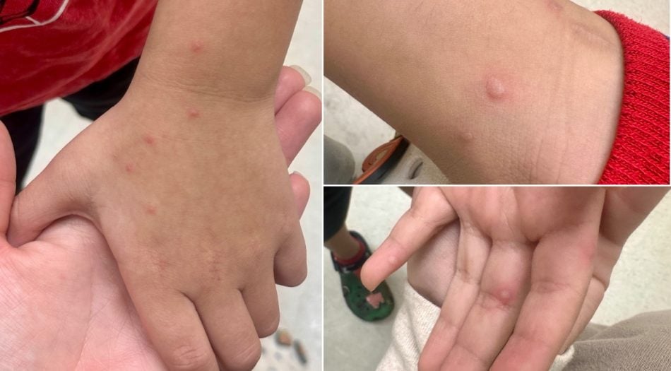 Hand Foot and Mouth Disease Memphis Tennessee